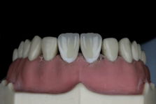 a-model-of-a-tooth-with-gums-on-it.jpg a model of a tooth with gums on it