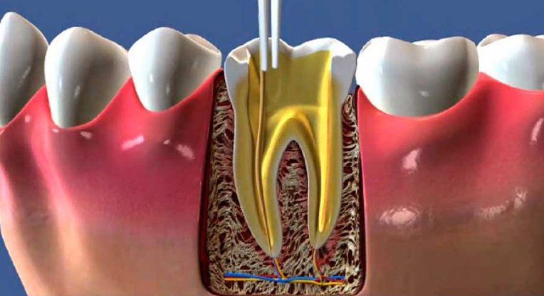 endodontia.png
